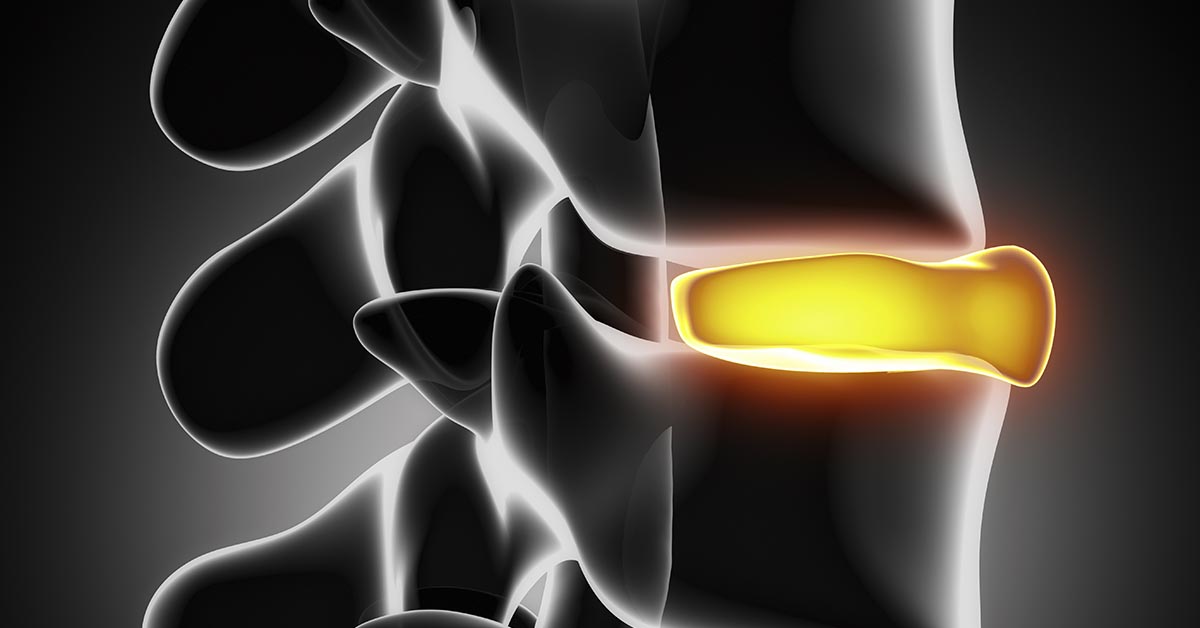 Spinal decompression therapy in Harrisburg