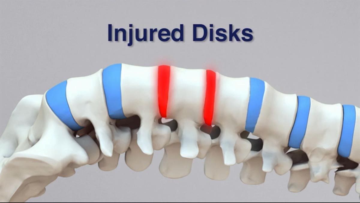 Harrisburg non-surgical spinal decompression